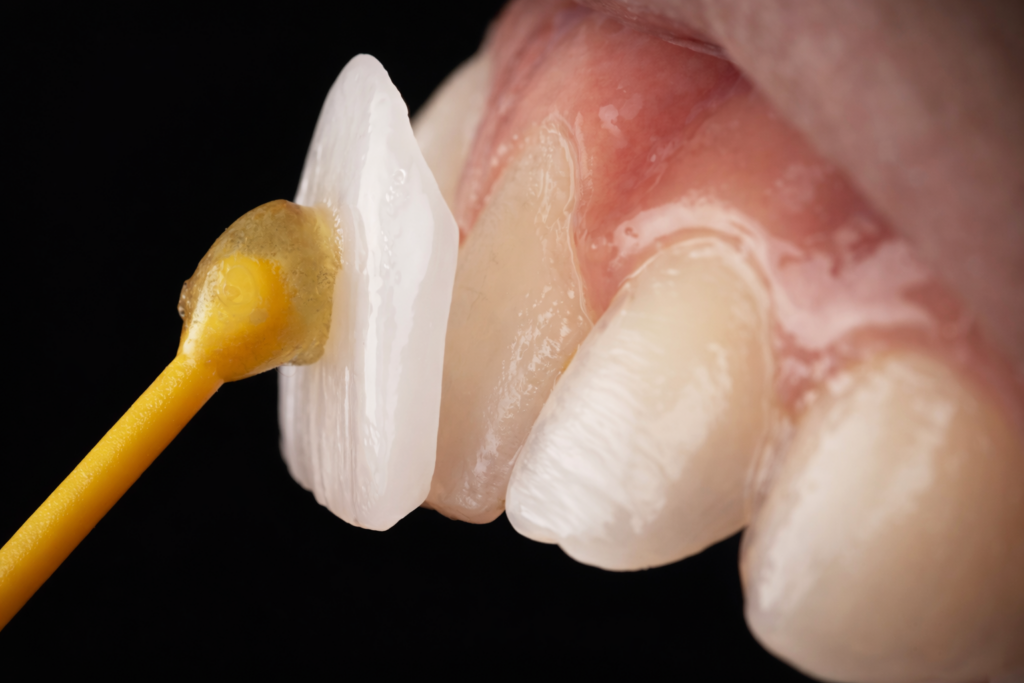 Facetas dentárias em Vila do Conde em cerâmica ou resina. Corrija manchas, fraturas e imperfeições estéticas com resultados rápidos e naturais.
