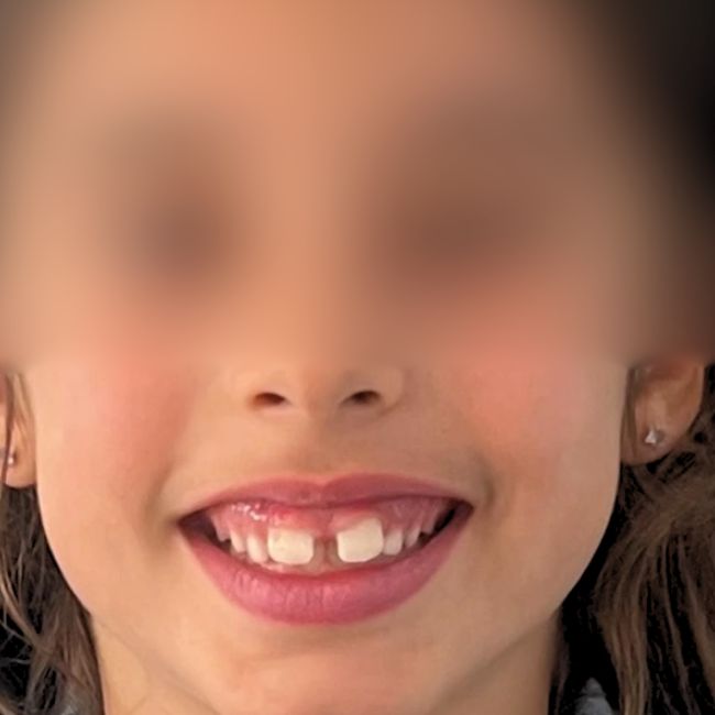 Antes: freio labial espesso com diastema, mordida coberta e compressão das arcadas | Centro Dentário da Praça, Vila do Conde

