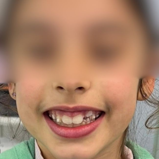 Depois: frenectomia e ortodontia interceptiva, arcadas expandidas e sorriso harmonioso | Centro Dentário da Praça, Vila do Conde


