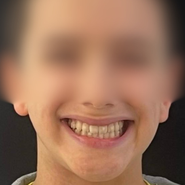 Depois: expansão dentoalveolar com alinhadores transparentes, oclusão equilibrada em crescimento | Centro Dentário da Praça, Vila do Conde

