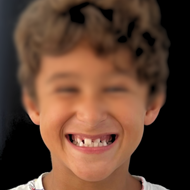 Antes: criança com mordida cruzada anterior, 8 anos | Centro Dentário da Praça, Vila do Conde

